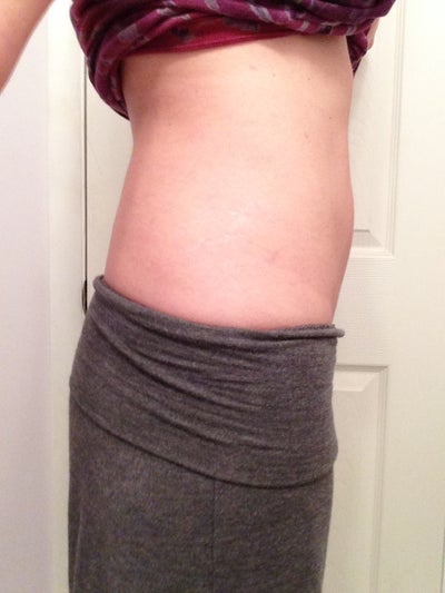 Getting Rid of my Muffin Top - Pittsburgh, PA - Review - RealSelf