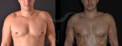 4D Lipo with fat transfer to pectorals - 	4D Lipo with fat transfer to pectorals