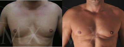 4D Lipo with fat transfer to pectorals - 	4D Lipo with fat transfer to pectorals
