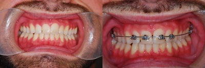 Incisal overlap correction with Fastbraces in 6 weeks - Patient was concerned about incisal overlap. It got corrected in less than 6 weeks with Fastbraces.