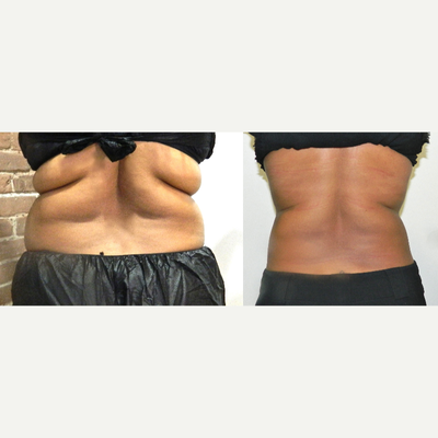 35-44 year old woman treated with i-Lipo - Treated with 12 sessions of ILipo + carboy