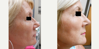 65-74 year old woman treated with Three for Me (Fine Lines, Wrinkles, Brown Spots, Facial Vessels) - Before & After 2 Treatments of IPL & 1540 Fractional (Three for Me). Patient will see more results after the 3rd treatment and continue to achieve better results until 6 months after the last treatment. That will be the end result, which we will post more in time!