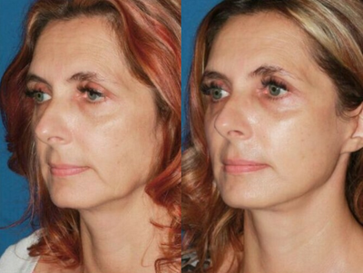 35-44 year old woman treated with Mini Facelift - Patient concerned with loss of smooth jawline contour and neck skin laxity, The mini facelift helped with facial contour and definition of the neck.