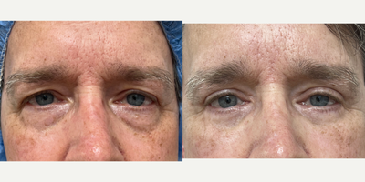 60 year old man treated with Eyelid Surgery - 60 y/o male with upper and lower eyelid surgery performed in our office O.R. under sedation.