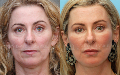 Cheek Augmentation Using Juvederm - This 56 year old San Francisco woman came in and spoke with Dr. Mabrie about getting more full lips. She felt this was important as she was still socially active in her life. Dr. Mabrie suggested not only injectable Dermafillers for her lips but also for the cheeks and under eye area. He expanded dermafiller usage to other areas, so this patient returned to fill out the cheeks and tear troughs (the lower, inner corners of the eyes). The additional procedure very effectively restored volume loss in the cheeks, filling in depressions and diminishing the dark circles beneath her eyes. Dr. Mabrie applied four syringes of Restylane, one each to her nasolabial folds, cheeks, tear troughs, and under eyes.