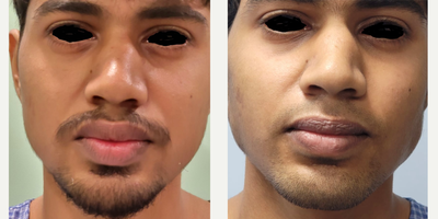 18-24 year old man treated with Lip Reduction - 20year old who underwent a lip reduction procedure