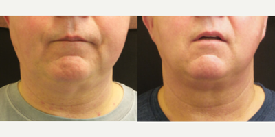 Man treated with CoolSculpting - Man treated with CoolSculptingto neck area