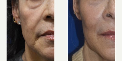 Los Angeles Sculptra Injections Before and After Photos - Patient is a 63 year old female that is very thin and volume depleted. Her primary concern was the hollow cheeks and folds around the mouth.  Sculptra is a perfect product for a patient like this and can provide amazing results by stimulating the production of the patient's own collagen, which can last 3 years or more.