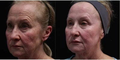 Woman treated with UltraClear Laser - Woman treated with UltraClear Laser