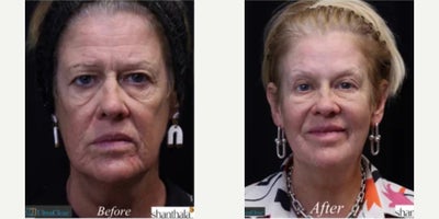 55-64 year old woman treated with CO2 Laser, Laser Resurfacing, Fractional Laser, UltraClear Laser - Life Changing Transformation with UltraClear Laser-Coring treatment at ShanthalaMD
