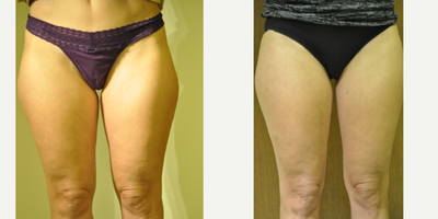 45-54 year old woman treated with TriPollar - TriPollar RF treatment for non-surgical fat reduction and contour improvement of inner and outer thighs.