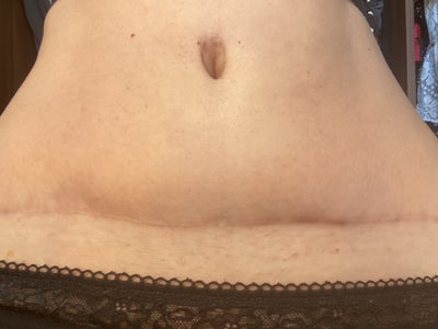 5 Months Post Op Tummy Tuck and Breast Uplift - Review - RealSelf