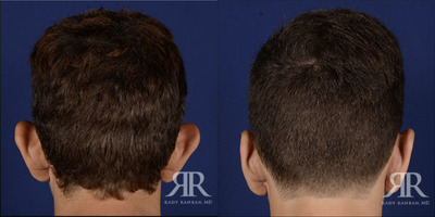 18-24 year old man treated with Ear Surgery - Ear Pinning Surgery