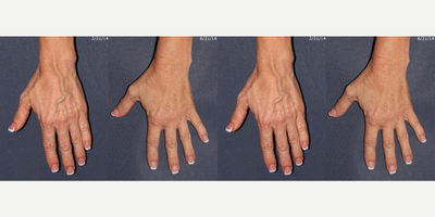 45-54 year old woman treated with Sclerotherapy - Dr. Goldman performed sclerotherapy to this patient's hands.