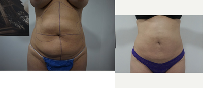 35-44 year old woman treated with Liposuction Revision - patient was treated with CoolSculpting at another facility with 8-applicators on the abdomen, back and inner thighs. she developed a rather serious complication called PAH which is very specific to only CoolSculpting, 3-months after receiving the treatment. the patient was treated and all her PAH masses were successfully removed using my minimally invasive technique of Revision Surgeries.