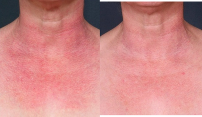 Vbeam (PDL) for chest - 
	Before and after Vbeam laser treatment to correct sun damage on neck and chest.
