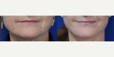 Woman treated with Neck Lift, Facelift - Woman treated with Neck Lift, Facelift