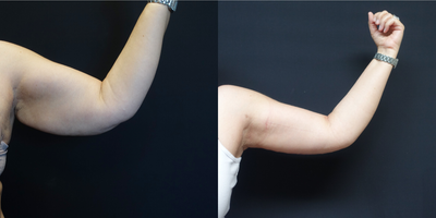 45-54 year old woman treated with Arm Lift - The patient underwent a brachioplasty (arm lift) to remove the excess fat and skin from around her arms. The images show her results at six weeks.