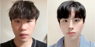 25-34 year old man treated with Double Eyelid Surgery, Ptosis Surgery, Canthoplasty, Rhinoplasty - 25-34 year old man treated with Double Eyelid Surgery, Ptosis Surgery, Canthoplasty, Rhinoplasty