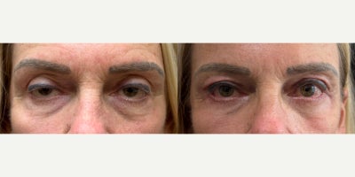 55-64 year old woman treated with Eyelid Surgery, Ptosis Surgery - 1 month after 4 lid blepharoplasty and upper eyelid ptosis repair