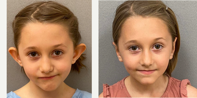 17 or under year old woman treated with Ear Surgery - 7 yo girl s/p otoplasty performed under local anesthesia in our on site AAAA certified operating suite.