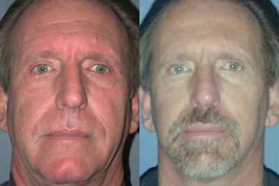 This gentleman received a Face Lift - This gentleman received a Face Lift.