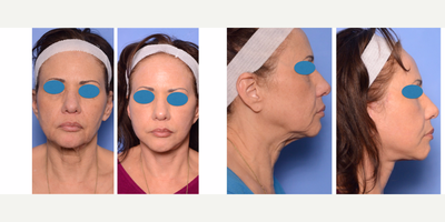 55-64 year old woman treated with Deep plane (HGH SMAS) Facelift - 62 year old female with High SMAS deep plane facelift. 2 year follow up photo. Also underwent laser resurfacing