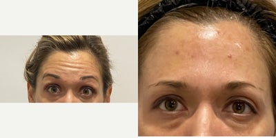 35-44 year old woman treated with Botox - Horizontal lines Botox results after 2 weeks