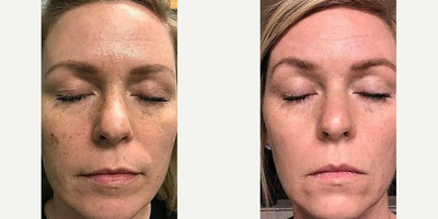 Woman treated with IPL, Lumecca - Lumecca Most powerful and focused IPL in the world! CLEAR BEAUTIFUL SKIN IN 1 WEEK? This patient had amazing results with LUMECCA after just one treatment! (Left: Before. Middle: Same day of treatment. Right: 1 wk after) 