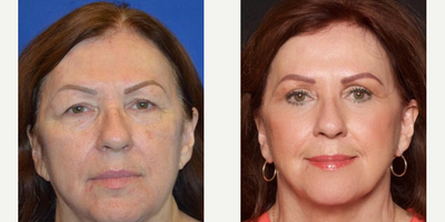 Woman treated with CO2 Laser - Looking to remove fine lines or wrinkles around the eyes, cheeks, or mouth? Minimize scars from acne or trauma? Stimulate collagen production to improve skin texture, or improve aged or sun-damaged skin? Double board-certified plastic surgeon, Dr. Vu Ho, uses the SmartSkin CO2 laser for laser skin resurfacing to achieve a variety of positive results.