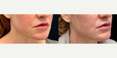 Woman treated with Thread Lift - Before and one week after threading procedure. Still some bruising and swelling. Keep checking back to see her progress