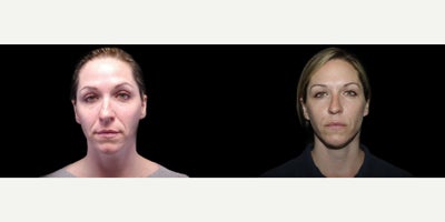 35-44 year old woman treated with Bellafill - 41 year old female received 2 syringes of Bellafill to the NLFs; photos depict the patient's results 3 months post-op.