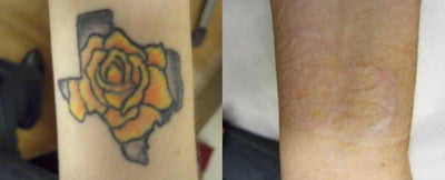 Tattoo Removal with PicoSure - Yellow rose of Texas tattoo removal using PicoSure