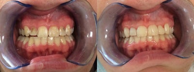 Dental Bonding (Front Teeth) - Patient had severe decay and browning of his teeth from years of neglect.  Patient's teeth were transformed in just one appointment at our office.  This 2-hour appointment helped.  Even though,  veneers would have been a more permanent solution lasting more than 20 years, this patient opted for dental bonding which is more of a temporary fix because of the lower cost.
This case was done entirely by Sarah Thompson, DMD.