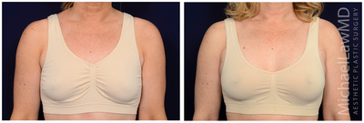 45-54 year old woman treated with Ideal Implant - Breast augmentation. Follow-up photos taken 8 months after the procedure.