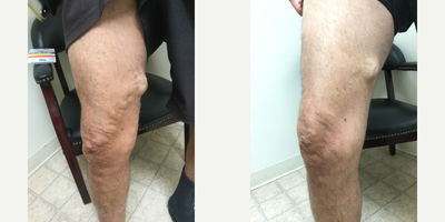 55-64 year old man treated with VenaSeal - Patient treated with VenaSeal on right leg with 1 treatment. Post-op picture taken 9 days after procedure.