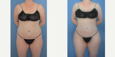 35-44 year old woman treated with Liposculpture, Liposuction, Brazilian Butt Lift - Woman in her early 40s, 4 months post-op BBL and lipo 360. The goal is a natural result.