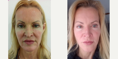 45-54 year old woman treated with MACS Facelift - macslift and superior and inferior eyelid, necklift