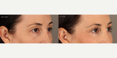 Upper and Lower Blepharoplasty with Fat Grafting and CO2 Laser - 38-year-old female with a history of displeasure with her upper eyelid contour and excess skin, and lower eyelid aging. She had tried and failed undereye fillers many times before deciding to undergo surgery. She is shown 6 months after an upper blepharoplasty (eyelid lift) with fat transposition to reduce upper eyelid skin redundancy and create a more youthful contour. She also underwent a transconjunctival (scarless) lower blepharoplasty to remove lower eyelid bags, fat grafting to the eyelids and mid-cheek to contour areas of hollowness, and fractionated CO2 laser to tighten and smooth skin.