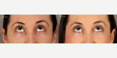 Upper and Lower Blepharoplasty with Fat Grafting and CO2 Laser - 38-year-old female with a history of displeasure with her upper eyelid contour and excess skin, and lower eyelid aging. She had tried and failed undereye fillers many times before deciding to undergo surgery. She is shown 6 months after an upper blepharoplasty (eyelid lift) with fat transposition to reduce upper eyelid skin redundancy and create a more youthful contour. She also underwent a transconjunctival (scarless) lower blepharoplasty to remove lower eyelid bags, fat grafting to the eyelids and mid-cheek to contour areas of hollowness, and fractionated CO2 laser to tighten and smooth skin.