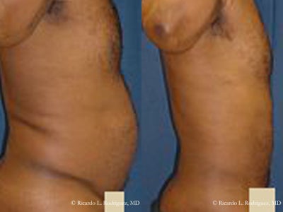 Liposuction - African-American, male, age 40's, lipo to abdomen and flanks