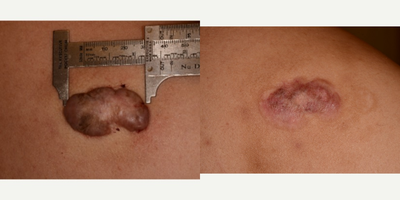 Large keloid treated with Cannula + Cryotherapy two cycles - 29 year old Asian man - This was a large keloid on the back of a 29 year old Asian man, refractory to many treatments over several years, including vascular laser, intralesional kenalog, and cryotherapy. I performed an interlesional cryotherapy technique using a flexible metal cannula, which allows for the keloid to be treated from the inside. This resulted in a reduction of ~95% of the bulk of the keloid after two treatments 6 weeks apart. The area is now soft and flat. This is the result 3 months after the first treatment.