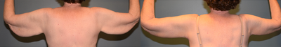 55-64 year old woman treated with Arm Lift - This 64 year old woman is 5'7 tall and weighs 165 lbs. She lost 133 lbs. through diet and exercise during the two years prior to this surgery. She had an arm lift, (brachioplasty), in which 240 grams of tissue was removed from the right arm and 232 grams from the left, (about 1/2 pound from each side). Her results are shown at 3 months after surgery.