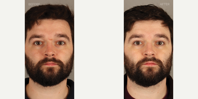 Mole Removal - Nose - 32-year-old male with a history of a displeasing mole at the top near the top of the nose, toward the center of the brow. He is shown 3 months after in-clinic removal, with no signs of any scar.