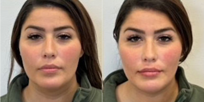 Woman treated with Lip Fillers - Woman treated with Lip Fillers