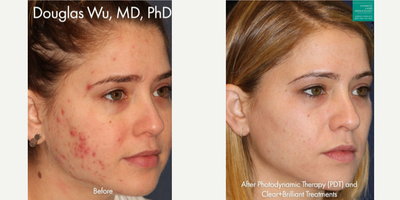 18-24 year old woman treated with Photodynamic Therapy - Photodynamic therapy with Clear+Brilliant to treat active acne in a female patient.