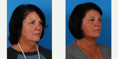 55-64 year old woman treated with Neck Lift - This is a 57 year old woman who desired a Neck Lift for her loose skin. The doctorperformed a Neck Lift and Embrace RF Facetite to her jowls.
