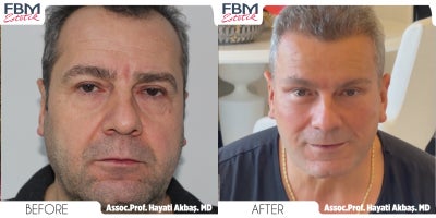 45-54 year old man treated with Deep Plane Facelift, Neck Lift, Alarplasty, Rhinoplasty, Eyelid Surgery, Facial Fat Transfer, Ha - 45-54 year old man treated with Deep Plane Facelift, Neck Lift, Alarplasty, Rhinoplasty, Eyelid Surgery, Facial Fat Transfer, Hair Transplant