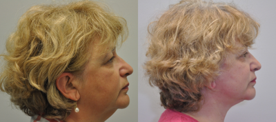 65-74 year old woman treated with Facelift - 68 year old female 2 years following a facelift with a neck lift, facial fat grafting and upper eyelid lift (Blepharoplasty).
