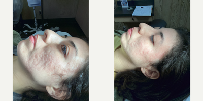 18-24 year old woman treated with Scar Removal Surgery - Taylor Liberator + Nokor needle subcision for deep acne scars